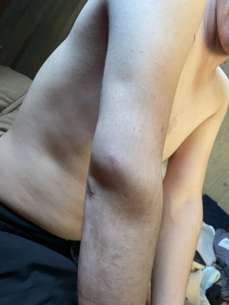 Swelling and bruise around the elbow.