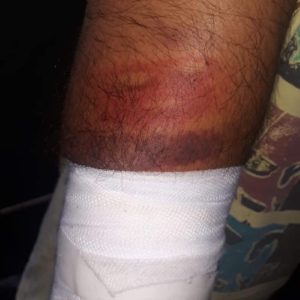 Injury after beating