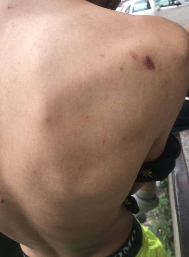 Back of respondent "A" after attack by Croatian Police 