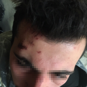 injury from baton beating on forehead