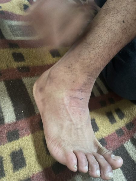 Injured foot